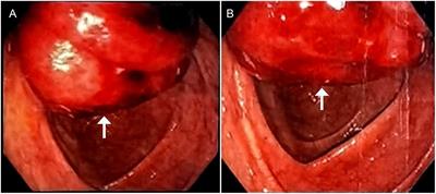 Extranodal marginal zone lymphoma of mucosa-associated lymphoid tissue of the ileum in an adult presenting with intussusception: a case report and literature review